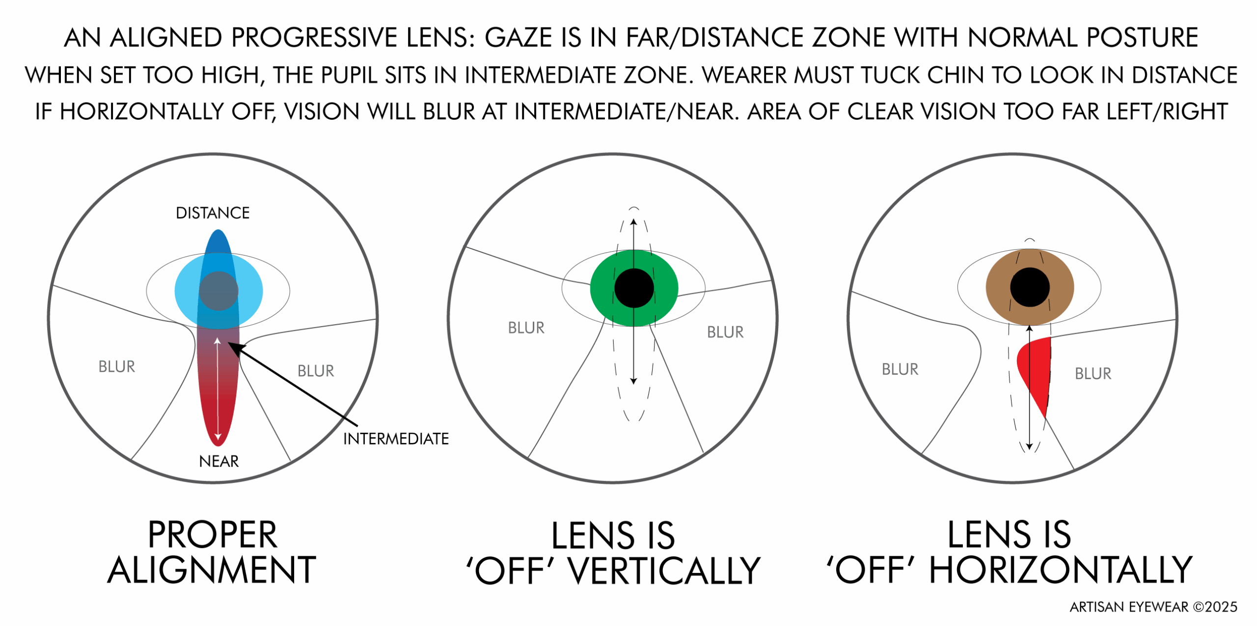 Misalignment A simple diagram of three progressive lens layouts. The first is a 'good' alignment, the other two show what a vertical and horizontal misalignment looks like.